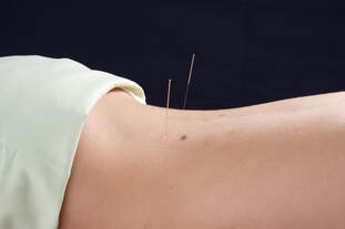 Wie funktioniert Akupunktur?